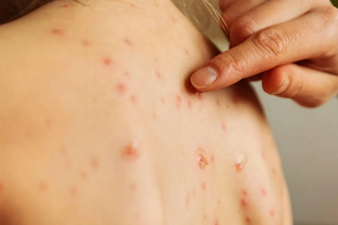 Morbillo, oltre 260 casi in Calabria con copertura vaccinale